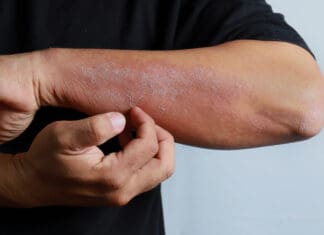 Ψωρίαση: Γιατί “φουντώνει” στις γιορτές;