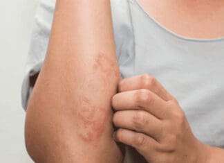 Αναφυλαξία: Τι πρέπει να γνωρίζετε για την κρίσιμη αλλεργική αντίδραση