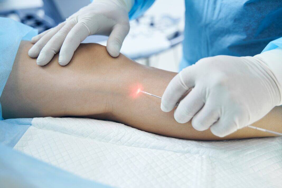 Doctor,Phlebologist,Is,Performing,Endovenous,Laser,Treatment