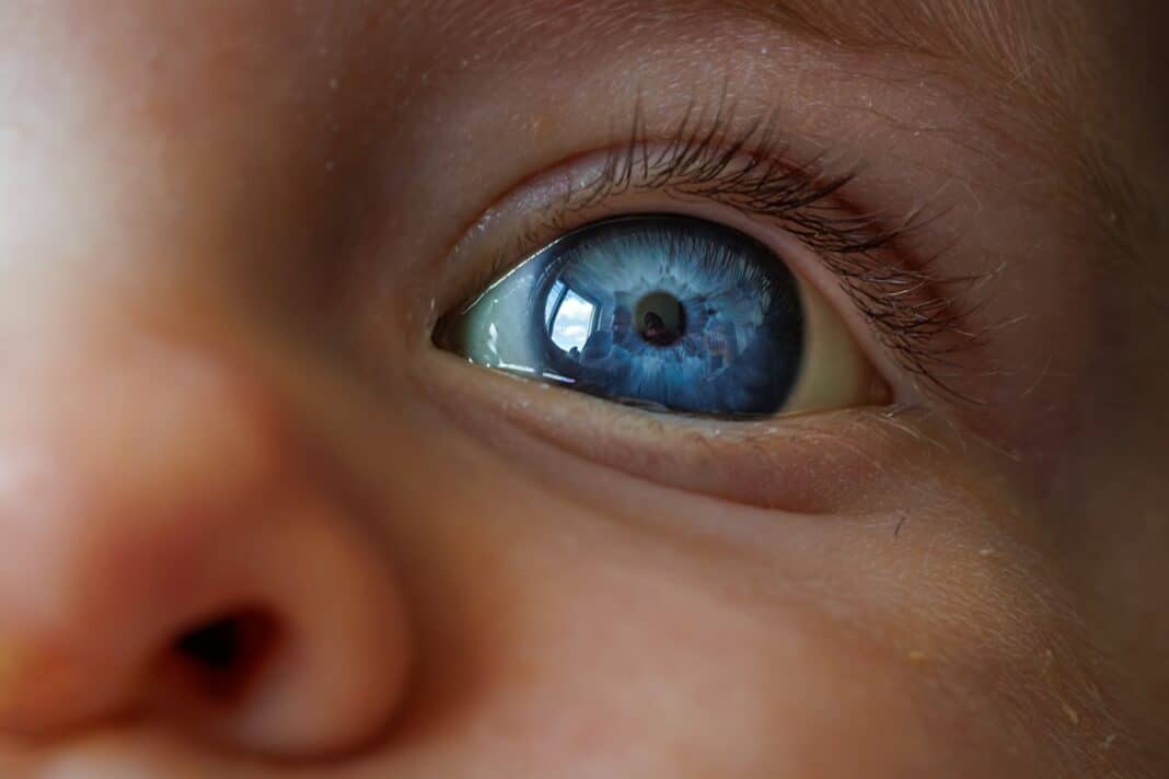 Close,Up,Of,Baby,Blue,Eye,Iris,With,Jaundice